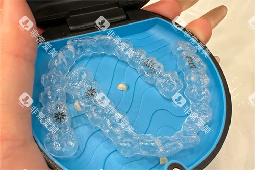 美国隐适美隐形矫正牙套