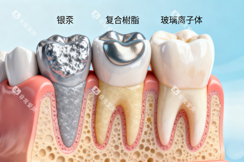 各类型补牙材料卡通图 各类型补牙材料卡通图