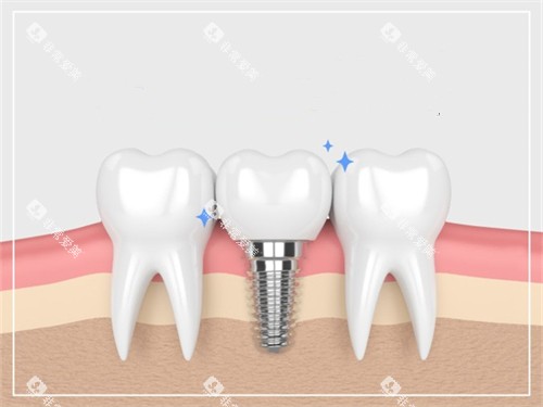 种植牙与真实牙齿漫画示意图 种植牙与真实牙齿漫画示意图