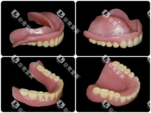 全口吸附性义齿实物展示图
