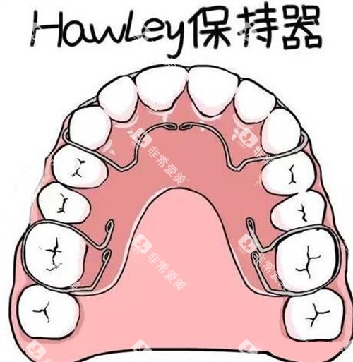 牙齿矫正Hawley哈雷保持器