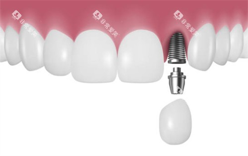 前牙区种植牙示意图