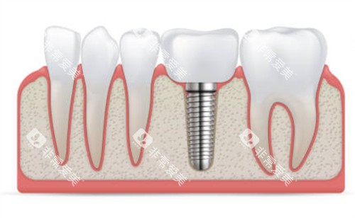 种植牙和临牙示意图