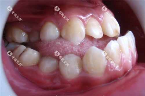 地包天牙齿照片