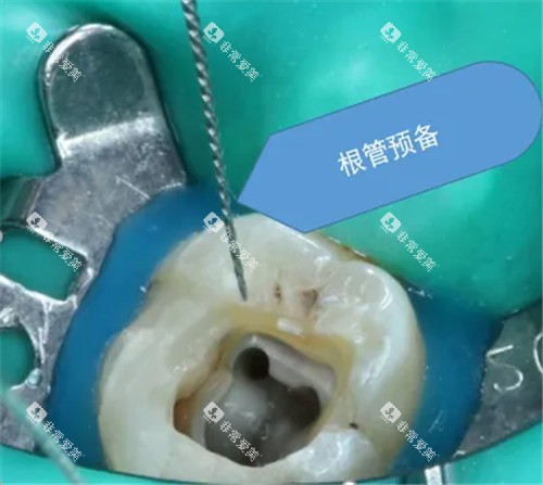 根管治疗治疗图