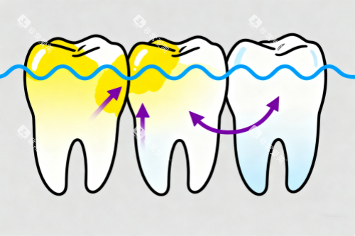 牙齿美白变化图