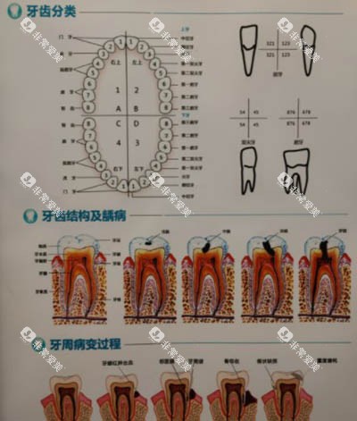 牙齿龋坏发展过程图