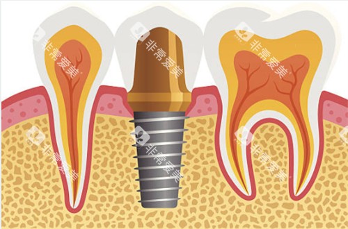种植牙和临牙图片