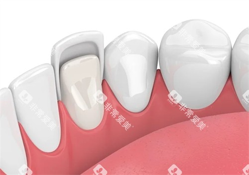 牙齿贴面在口腔内的样子