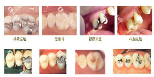 不同牙齿修补示意图