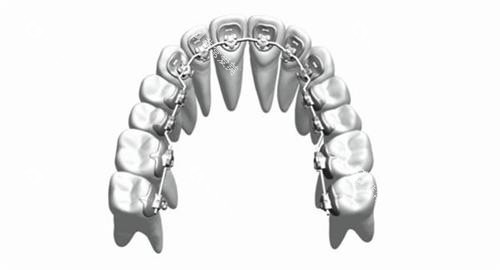 牙齿矫正舌侧矫正牙套概念透视图
