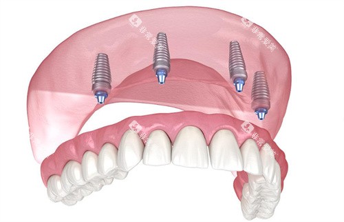 种植牙动画示意图片 种植牙动画示意图片