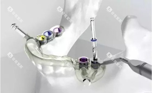 种植牙导板在手术中的应用 种植牙导板在手术中的应用