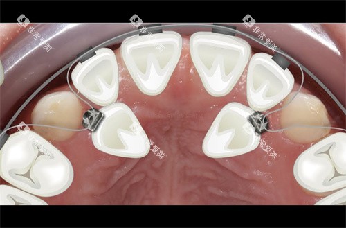 两颗牙齿牵引 两颗牙齿牵引