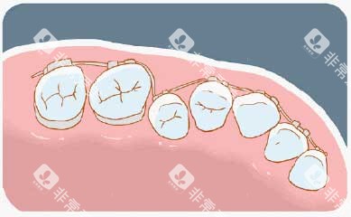 牙齿矫正漫画牙齿图 牙齿矫正漫画牙齿图