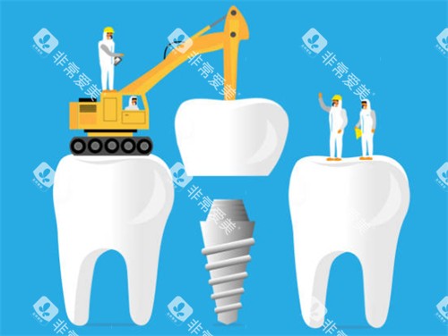 种植牙工程示意图