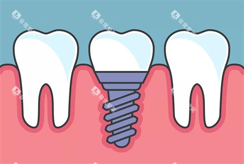 种植牙植入后漫画示意图