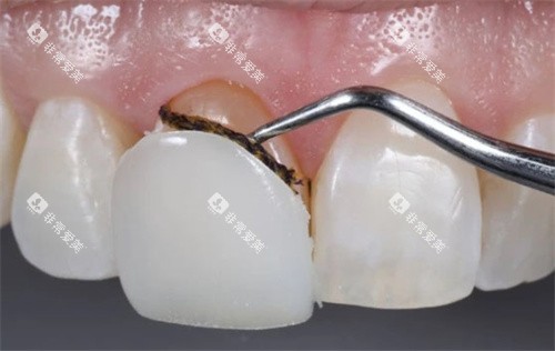 取下树脂贴面 取下树脂贴面