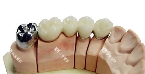 不同种类的烤瓷牙