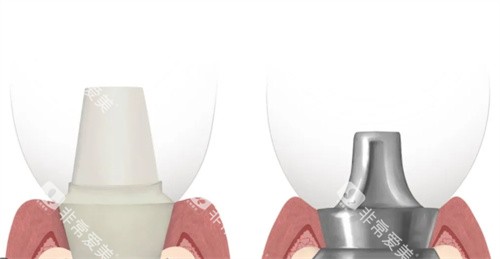 瑞士百丹特种植牙基台连接对比