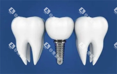种植体与真实牙齿对比漫画图