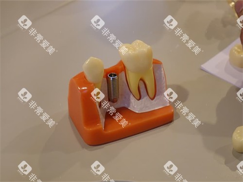 种植牙植体和牙齿模型图