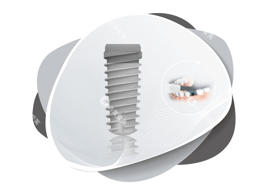 大清西格种植牙照片图