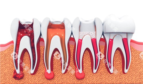 牙科根管治疗过程图