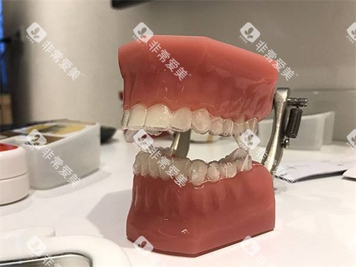 隐形牙齿矫正牙套模型