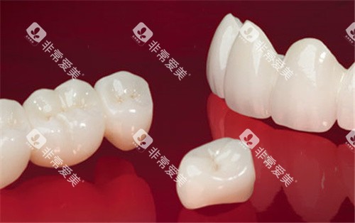 lava全瓷牙展示 lava全瓷牙展示