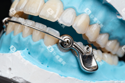 牙齿安装保持器一览