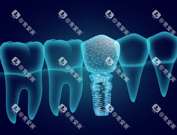 种植牙模型图卡通图