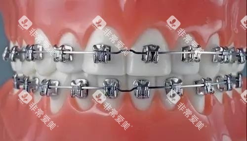 金属牙套示意图 金属牙套示意图