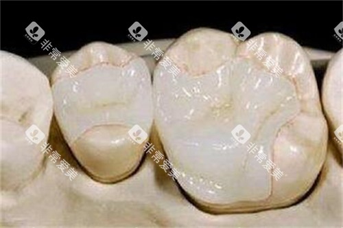 牙齿修复改善照片图 牙齿修复改善照片图