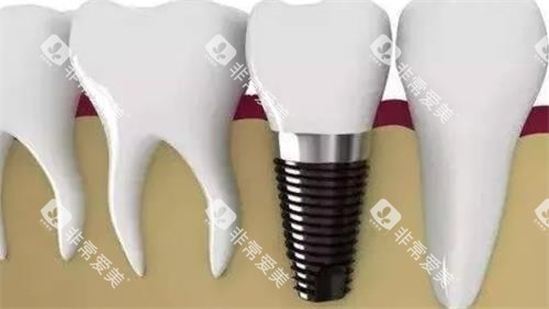 种植牙后效果图 种植牙后效果图