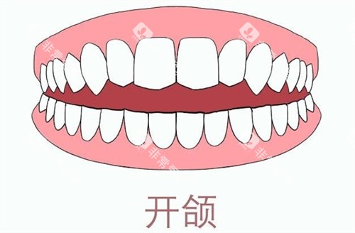 牙齿开颌 牙齿开颌