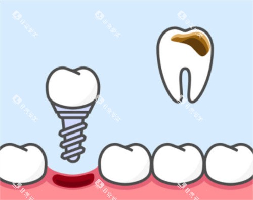 牙齿坏了换种植牙