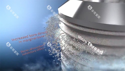 沃兰种植牙表面材料图 沃兰种植牙表面材料图