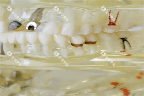 种植牙图展示 种植牙图展示