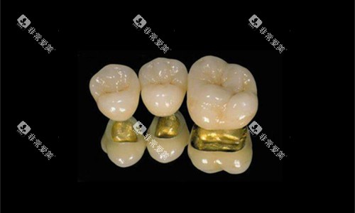 各类金属烤瓷牙展示图