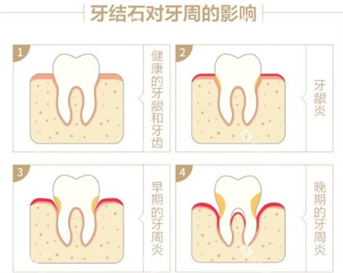 牙结石对牙周的影响