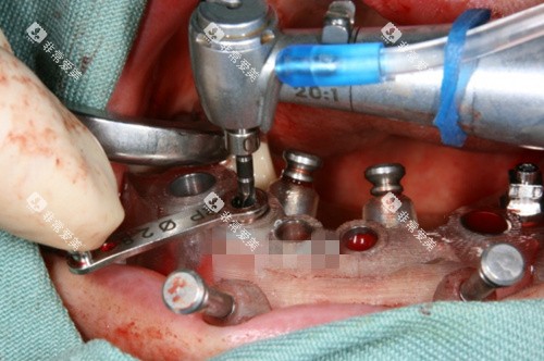 种植牙导板手术实拍 种植牙导板手术实拍