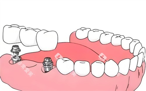 种植牙材料卡通展示图