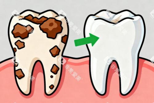 洗牙前后对比图