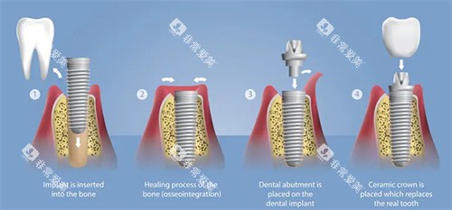 种植牙手术流程图 种植牙手术流程图