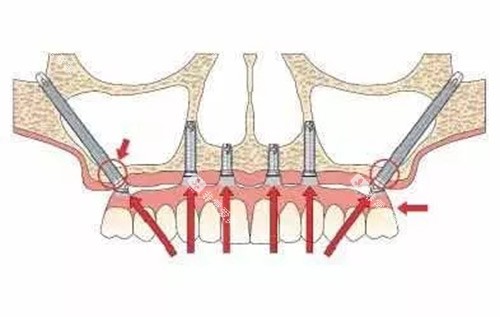 穿颧穿翼种植 穿颧穿翼种植