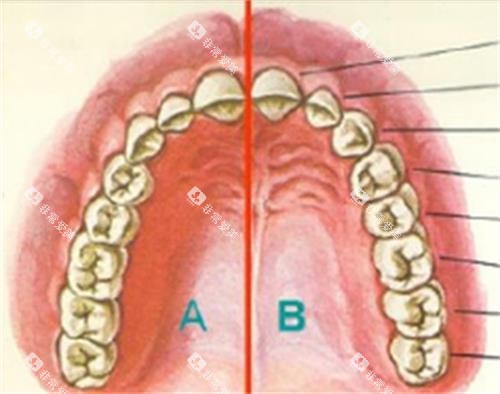 穿颧穿翼种植示意图 穿颧穿翼种植示意图