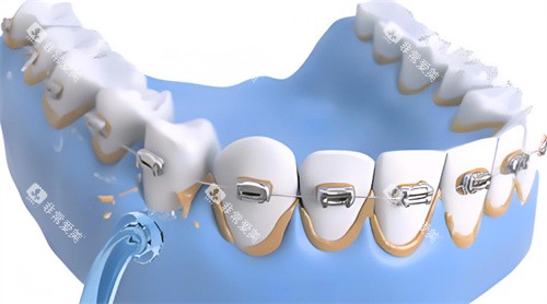 洗牙过程动画展示图片 洗牙过程动画展示图片