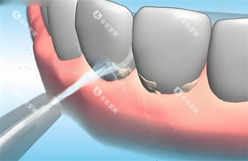 洗牙动画展示图片 洗牙动画展示图片