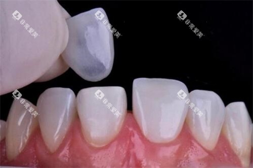 牙齿贴面修复改善图